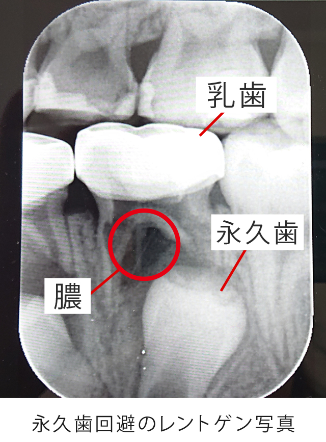 乳歯のむし歯